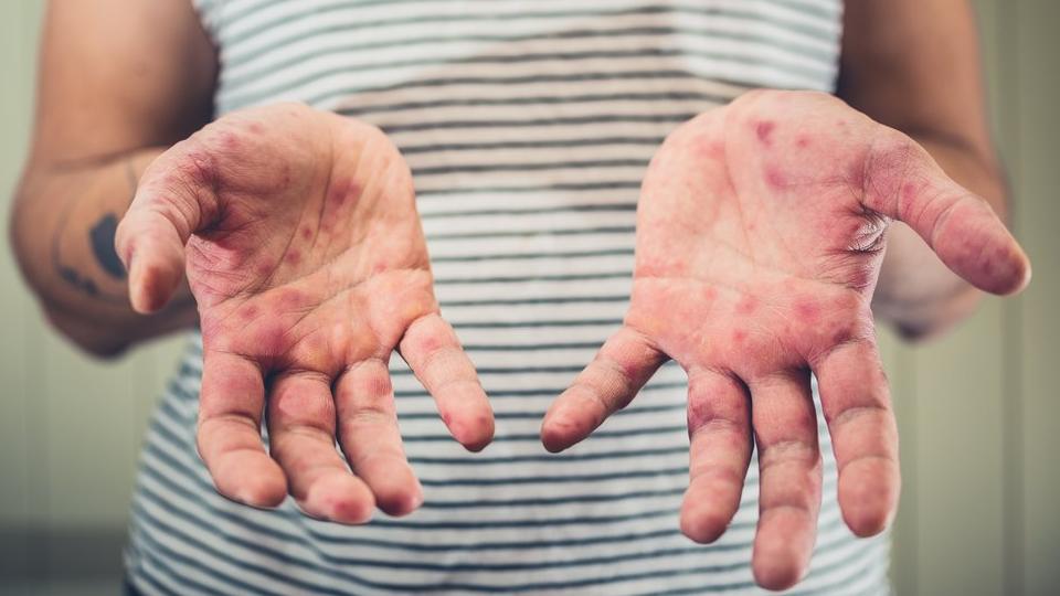 Governo lança campanha para enfrentar aumento do Sarampo